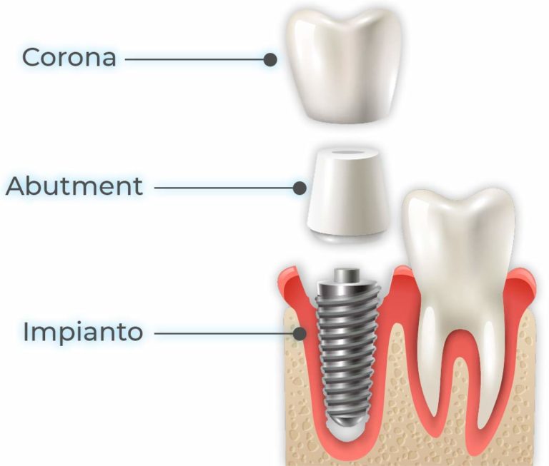 Impianti Dentali Tutto Quello Che Devi Sapere Mp Dental Studio