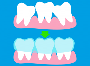 Invisalign: cos'è e come funziona? La guida completa