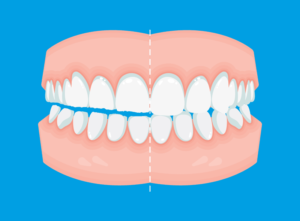 Soffri di bruxismo? Perché risolverlo prima di mettere un impianto