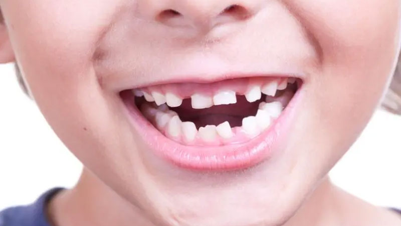 Bambino con denti storti