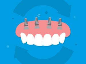 A cosa serve la protesi provvisoria su impianti dentali?