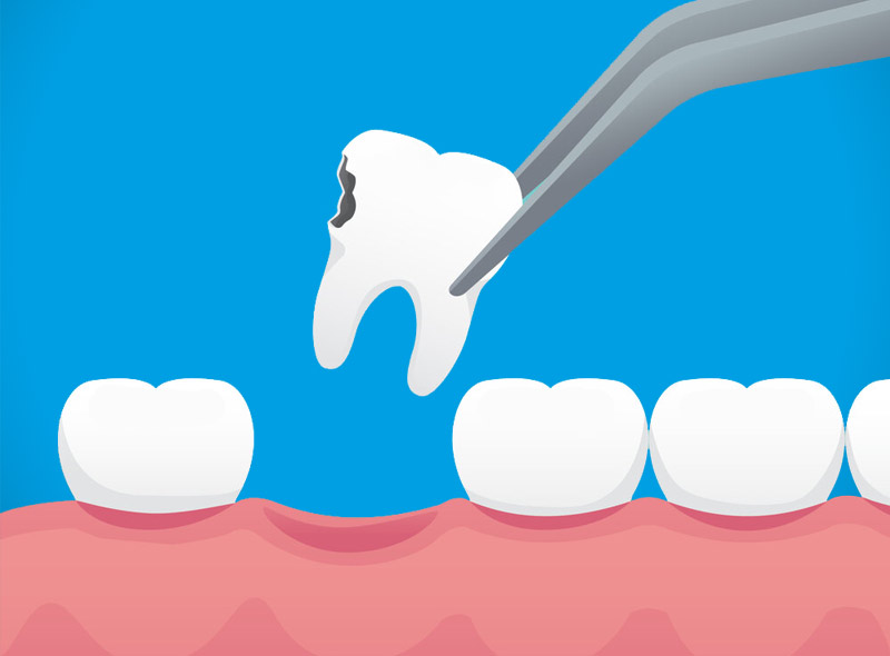 Ortodonzia: 3 problemi dentali che richiedono estrazioni