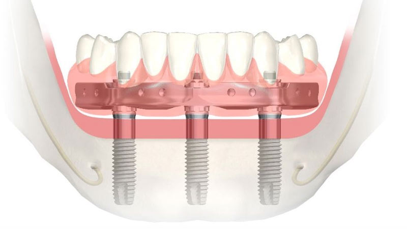 Protesi dentaria fissa su 3 impianti dentali