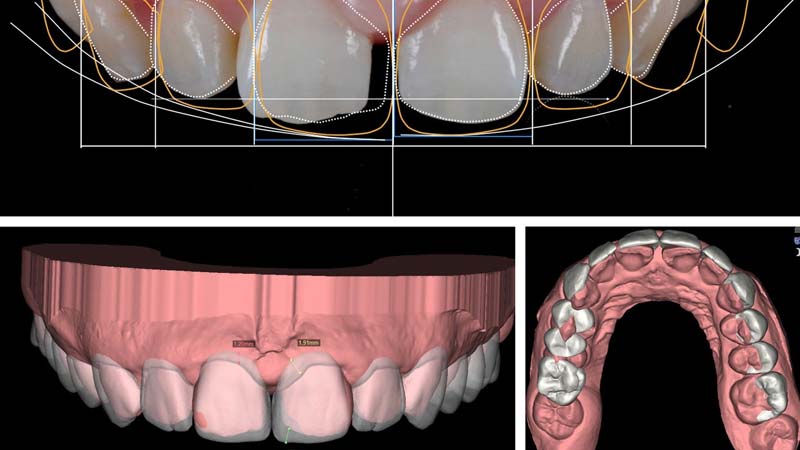 Come migliorare l'aspetto del sorriso con l'odontoiatria estetica