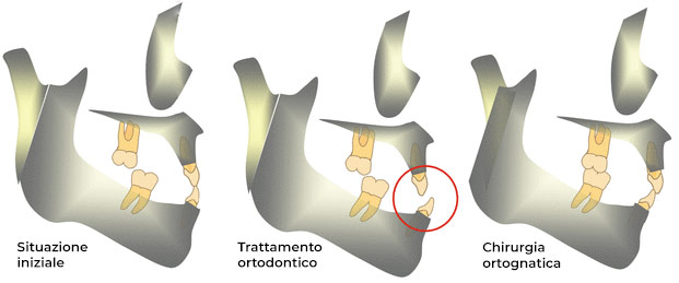 Approccio orthodontics-first in un trattamento combinato di chirurgia ortognatica e ortodontica